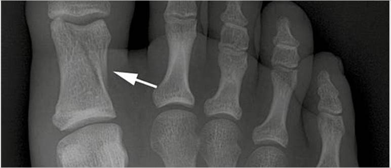 Pictures of fractured toes